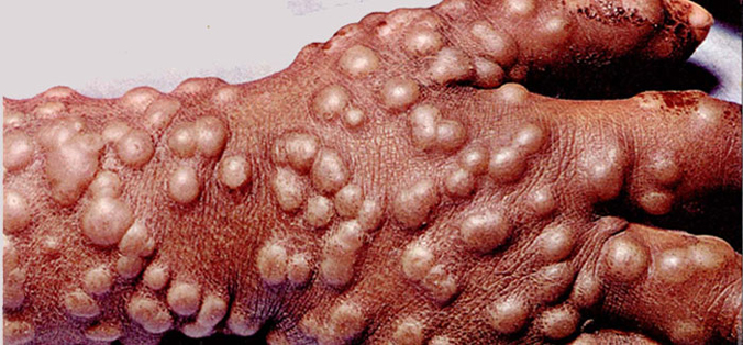 Washington, Smallpox, and the Fight for Independence